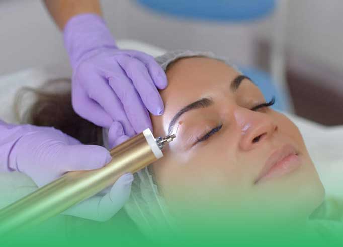 خال چیست؟ برداشت خال بدون جراحی - روبراه